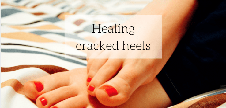What Causes Cracked Heels & How To Cure Them Naturally? – Vedix