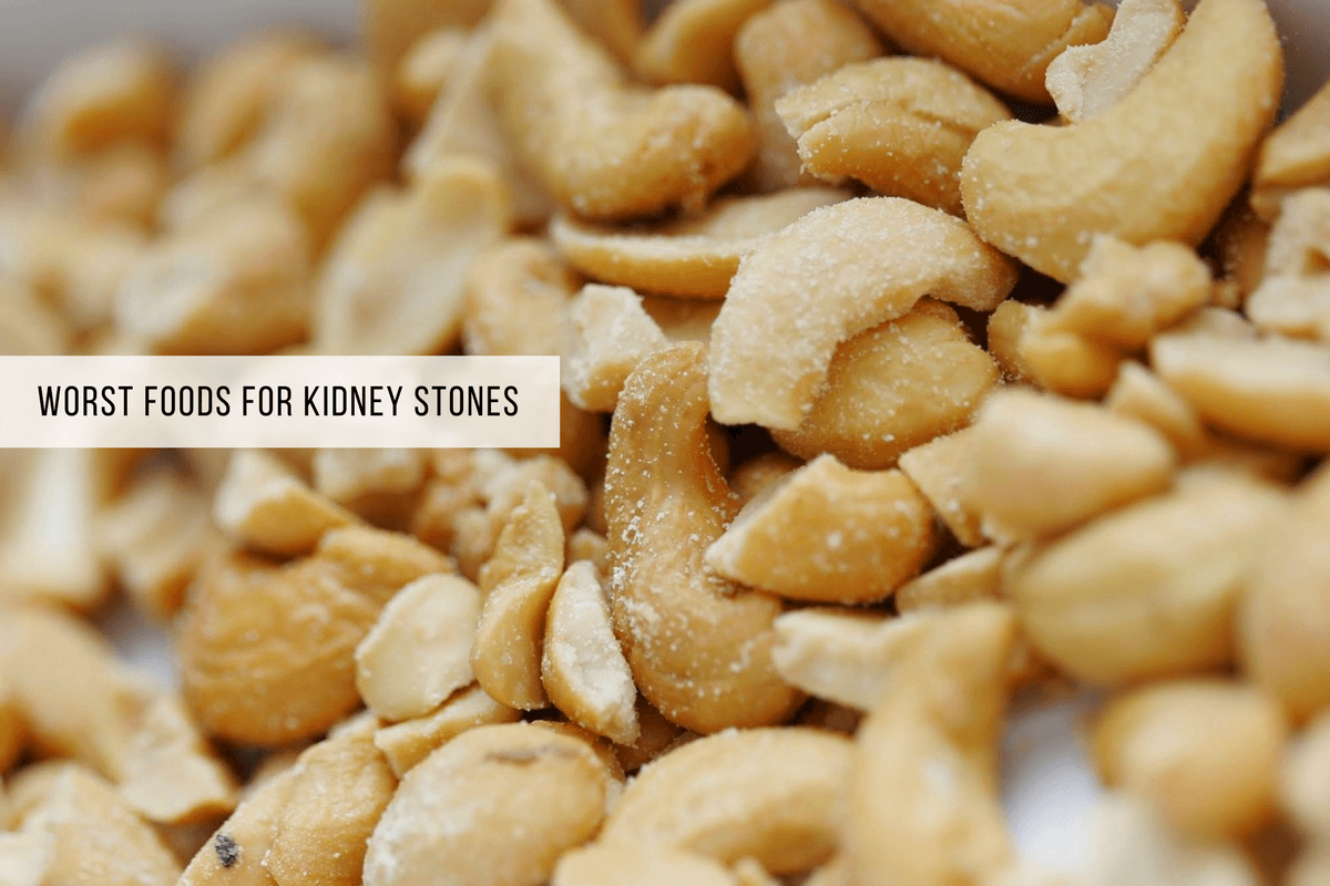 Your Diet Matters! 6 Foods To Avoid For Kidney Stones
