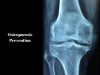 osteoporosis prevention