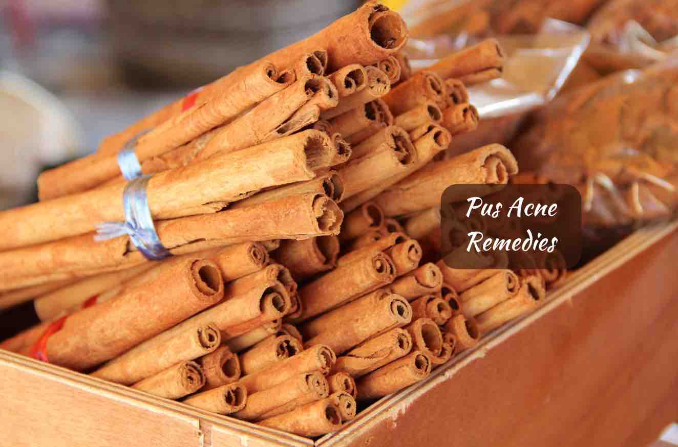 Best Acne Treatment Remove Pus Filled Pimples Easily & Naturally