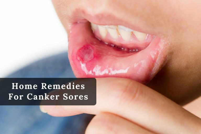 how to get rid of canker sores fast