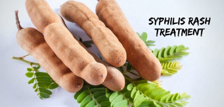 Syphilis rash treatment _ Ayurvedum