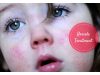 Roseola Rash Treatment _ Ayurvedum
