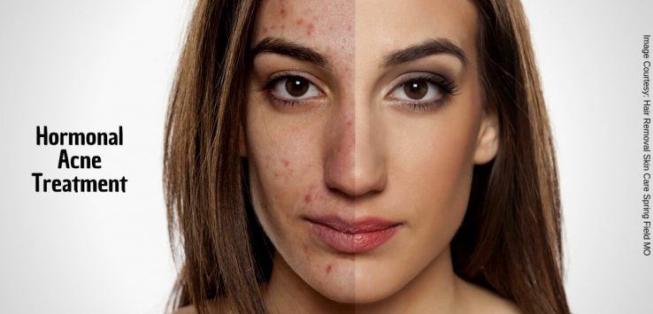 How to get rid of hormonal acne _ Ayurvedum