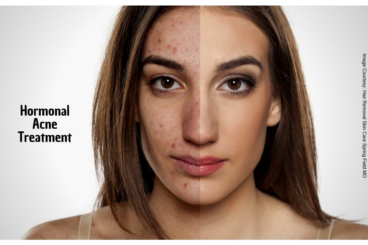 How To Get Rid Of Hormonal Acne Without Using Chemical Drugs?