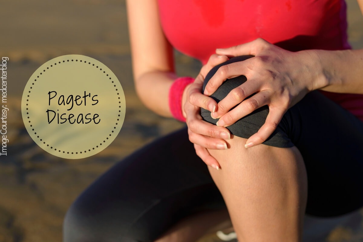 Paget’s Disease A Chronic Bone Disease And Its Treatment