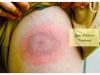 Lyme disease _ Ayurvedum