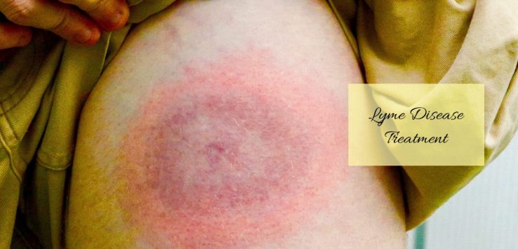 Lyme disease _ Ayurvedum