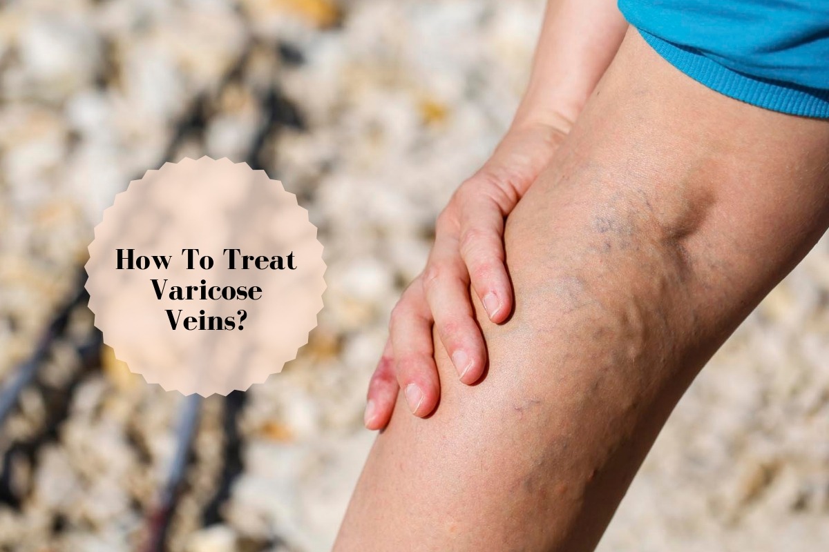 Varicose Veins Ayurvedic Treatment With Herbs And Teas