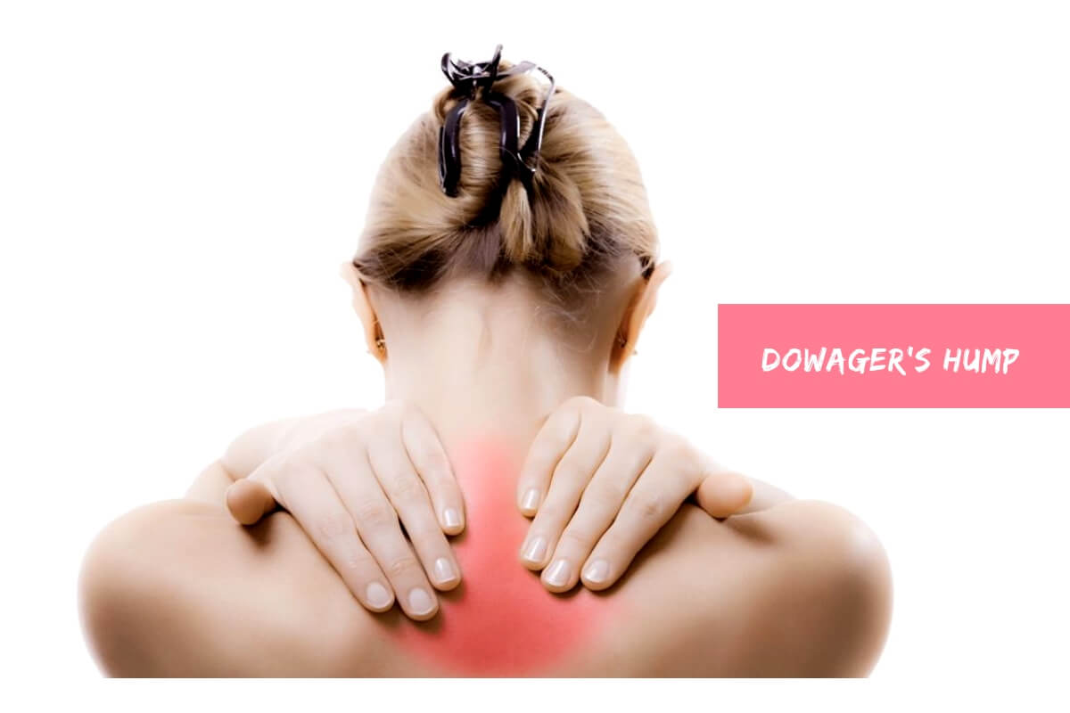 Dowager’s Hump Here’s How To Heal A Humpback At Home